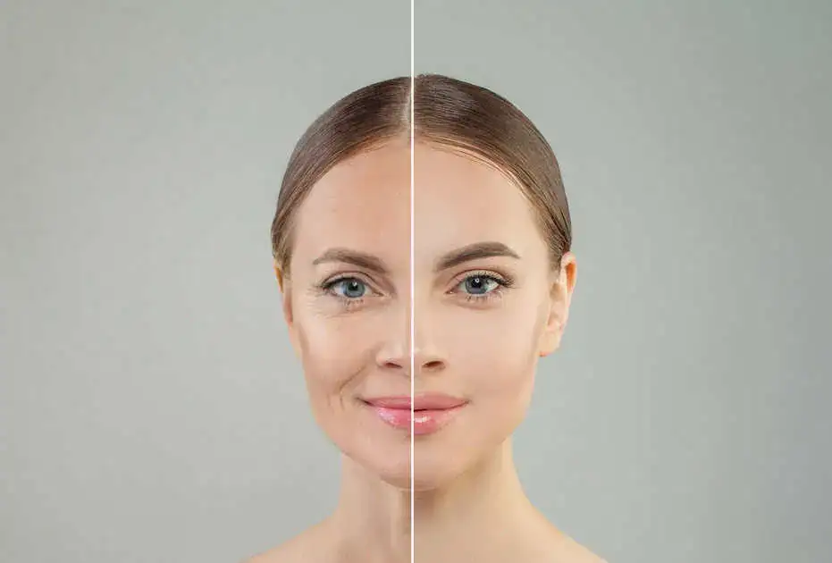 Ulthera anti-aging treatment targeting the SMAS layer to lift and tighten facial skin without surgery